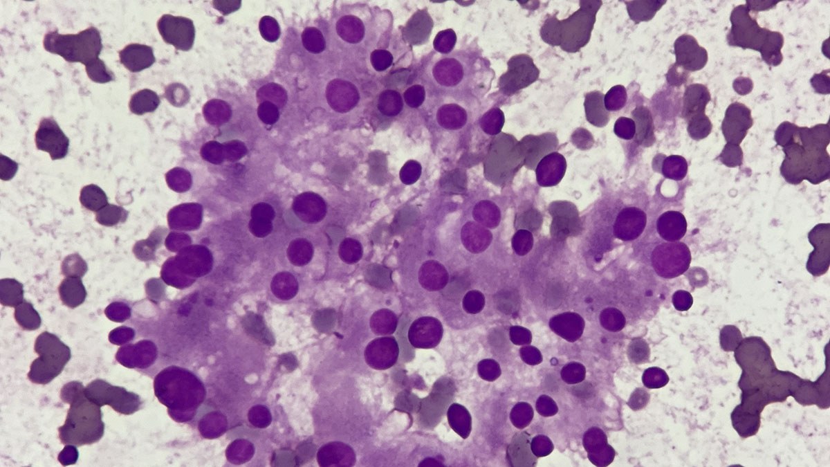 Thyroid cytology under the microscope
